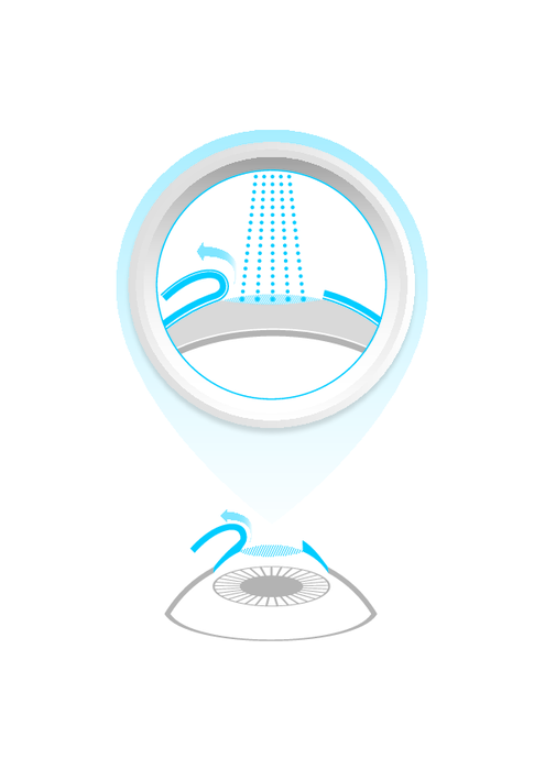 LASIK Treatment Schematic Graphic (med-large)